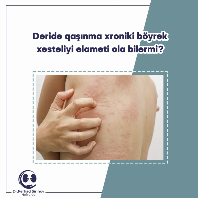 Dəridə qaşınma xroniki böyrək xəstəliyi ola bilərmi?