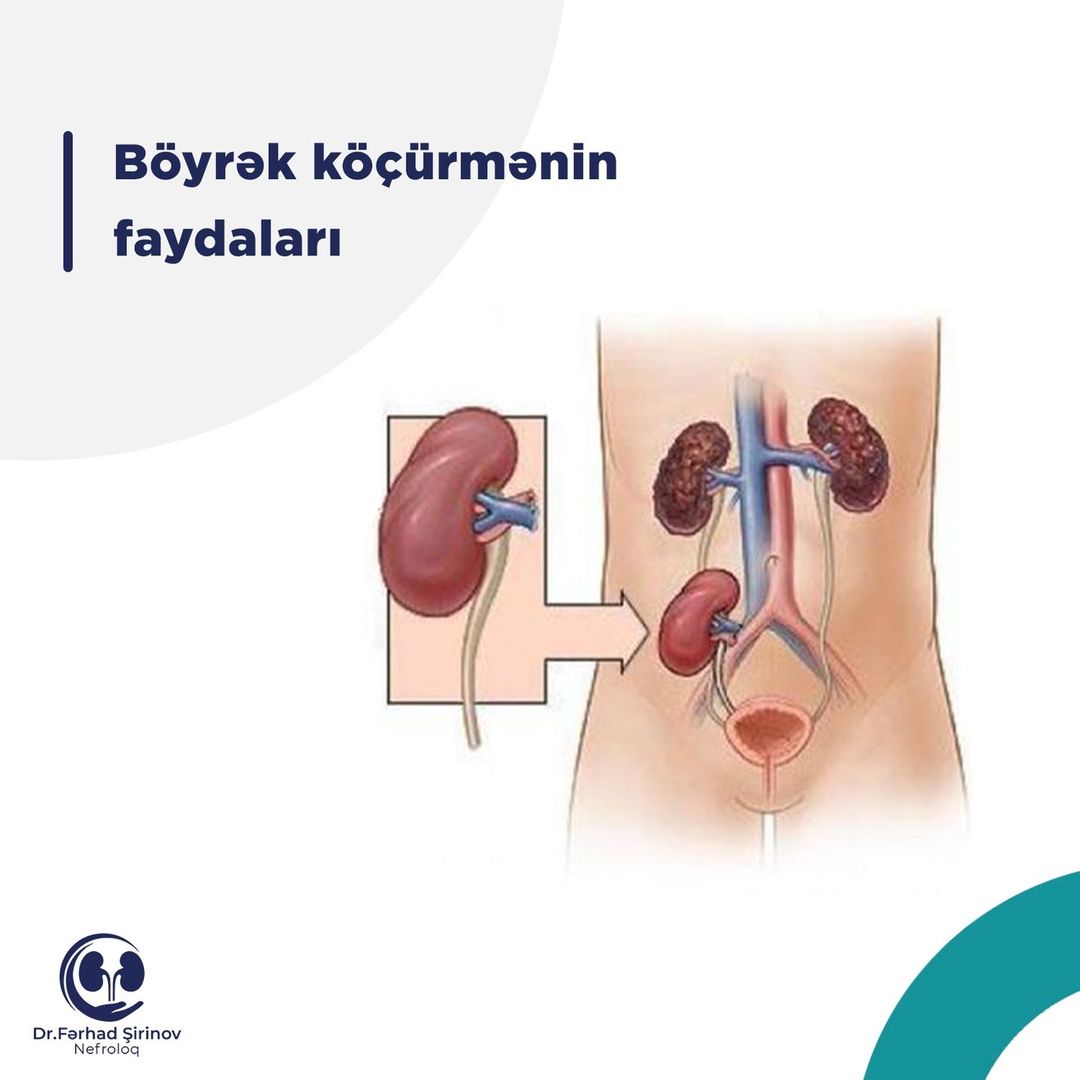 Böyrək köçürmənin faydaları