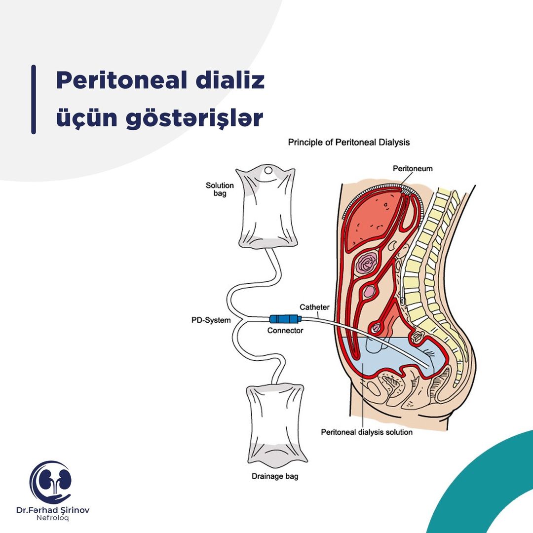 Peritoneal dializ üçün göstərişlər