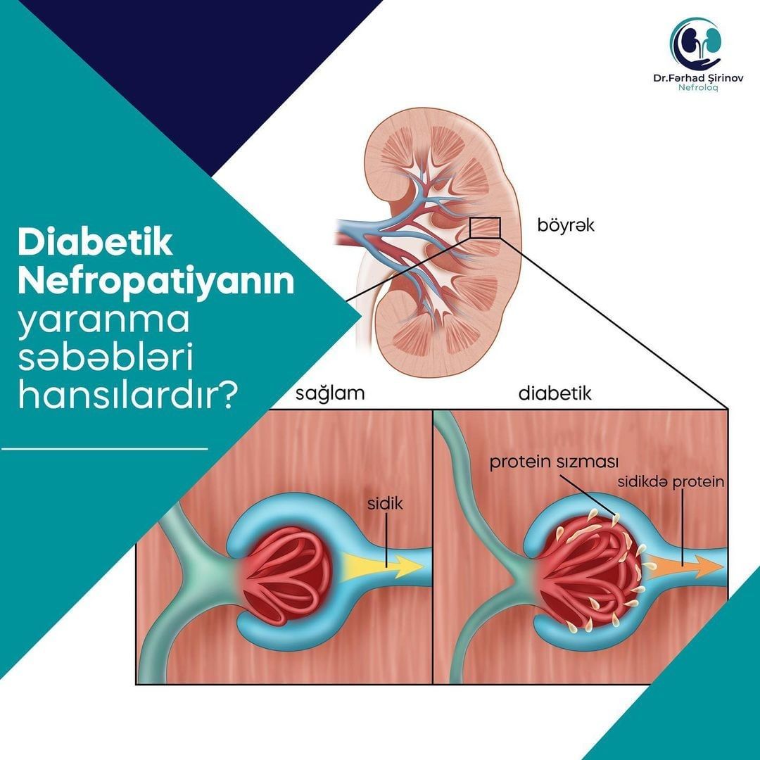 Nefroloq,&nbsp;Diabetik nefropatiya
