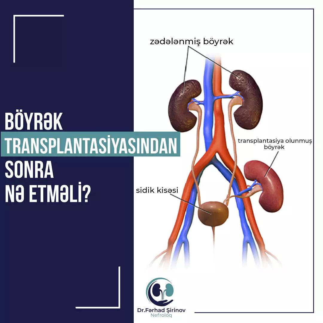 Nefroloq,&nbsp;Böyrək transplantasiyası