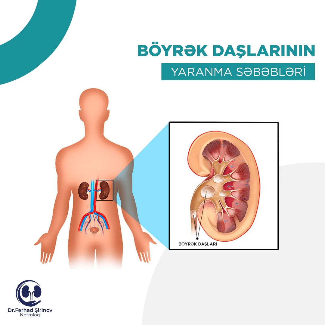 Böyrək daşlarının yaranma səbəbləri