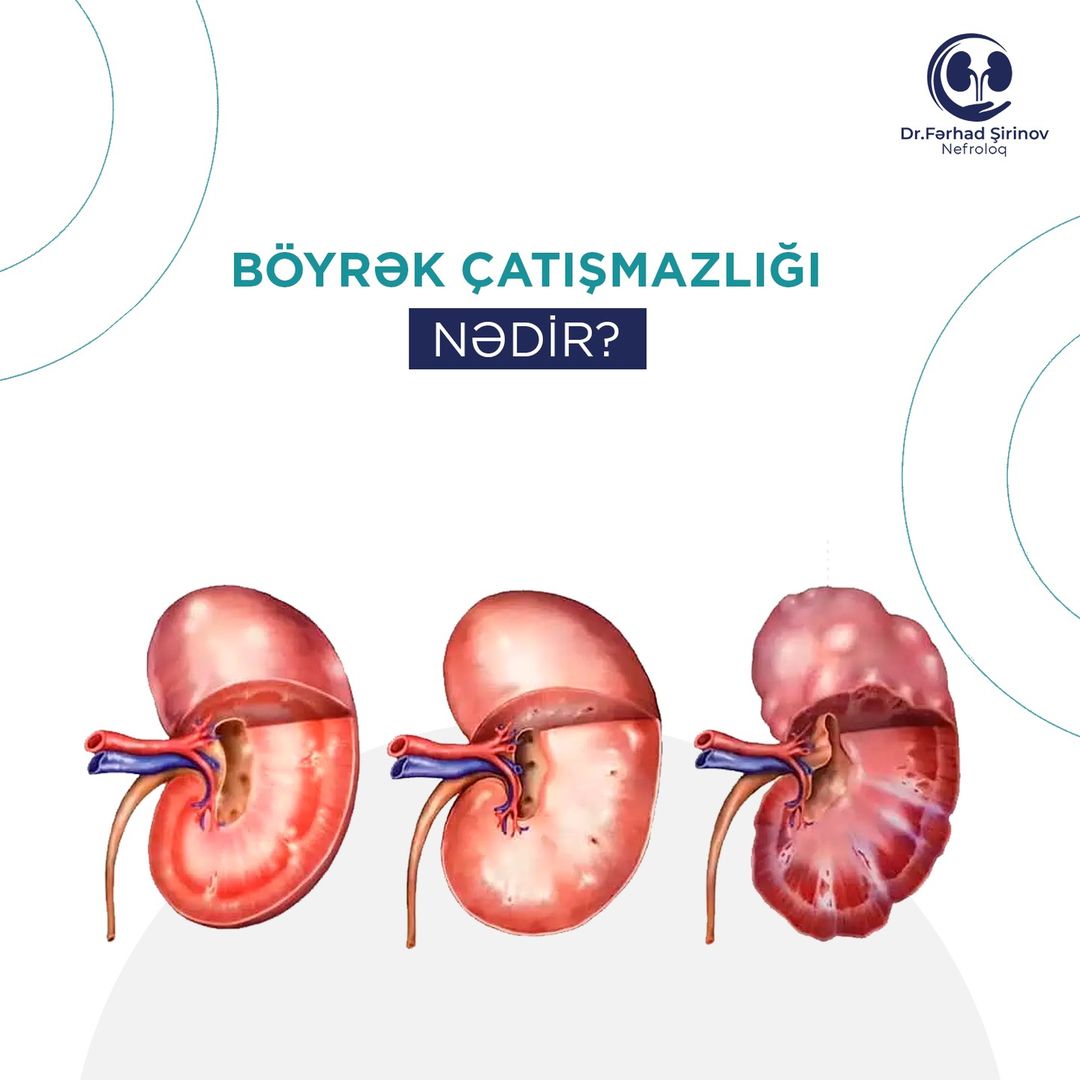 Böyrək Çatışmazlığı Nədir?